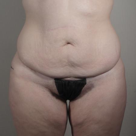 Before image 1 Case #124541 - Tummy tuck Patient #1578