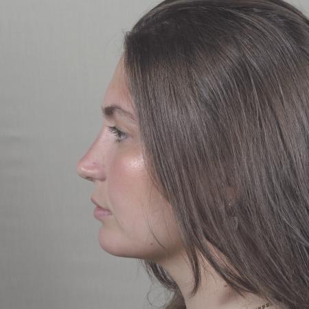 After image 2 Case #124566 - Rhinoplasty with chin augmentation Patient #1416 