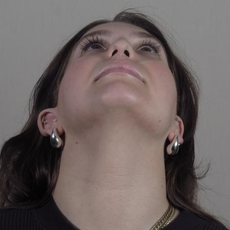 Before image 3 Case #124566 - Rhinoplasty with chin augmentation Patient #1416 