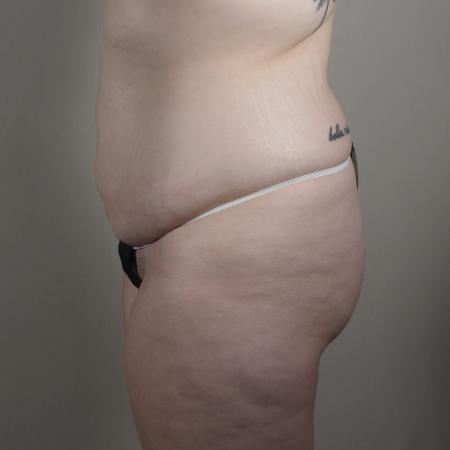Before image 2 Case #124541 - Tummy tuck Patient #1578