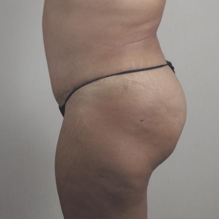 After image 2 Case #124536 - Tummy Tuck with Liposuction Patient #1482