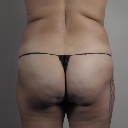 Before image 3 Case #124536 - Tummy Tuck with Liposuction Patient #1482