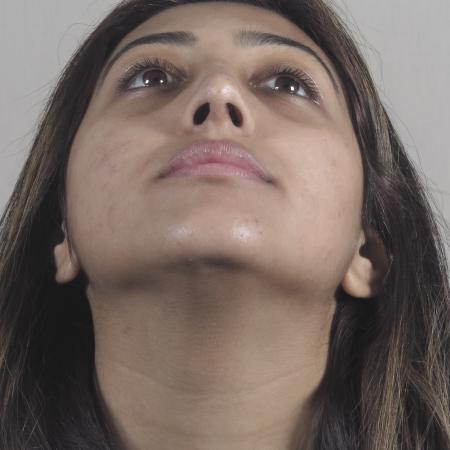 After image 3 Case #124571 - Rhinoplasty Patient #1449