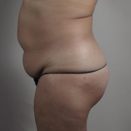 Before image 2 Case #124536 - Tummy Tuck with Liposuction Patient #1482
