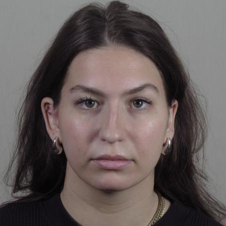 Before image 1 Case #124566 - Rhinoplasty with chin augmentation Patient #1416 