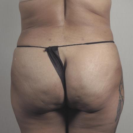 After image 3 Case #124536 - Tummy Tuck with Liposuction Patient #1482