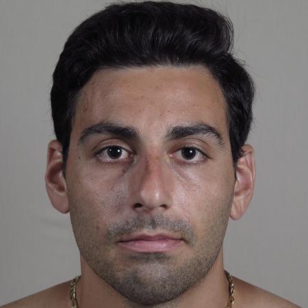 Before image 1 Case #124576 - Rhinoplasty Patient #1433
