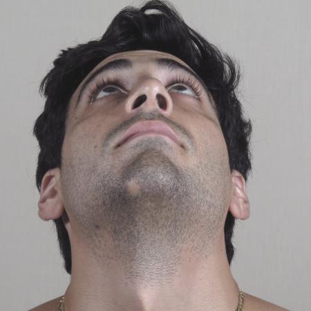 After image 3 Case #124576 - Rhinoplasty Patient #1433