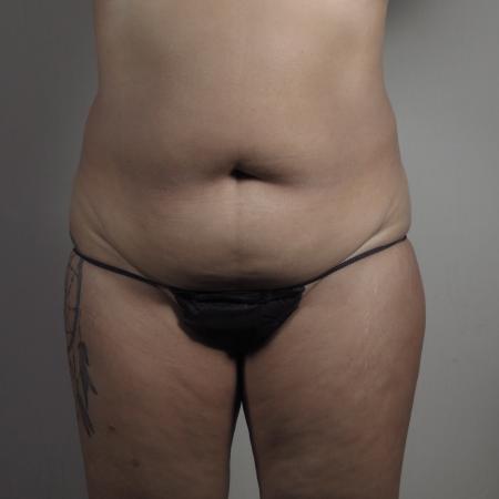 Before image 1 Case #124536 - Tummy Tuck with Liposuction Patient #1482