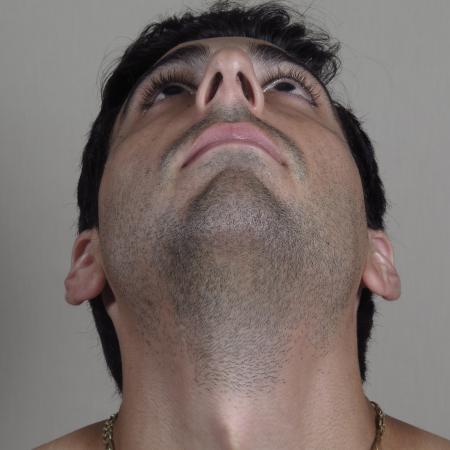 Before image 3 Case #124576 - Rhinoplasty Patient #1433