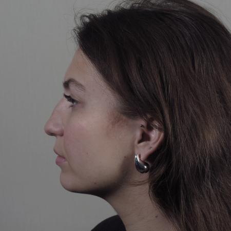 Before image 2 Case #124566 - Rhinoplasty with chin augmentation Patient #1416 