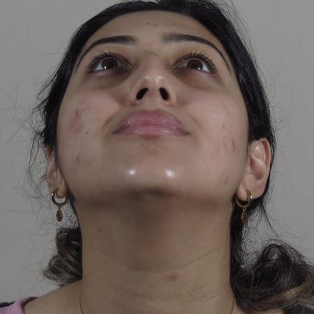 Before image 3 Case #124571 - Rhinoplasty Patient #1449