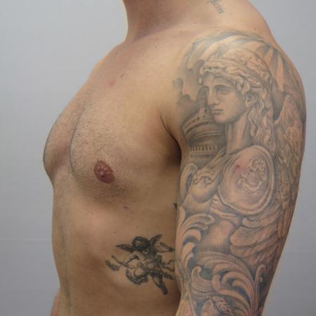 After image 2 Case #124681 - Gynecomastia Patient #1563 