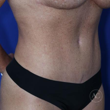 After image 2 Case #124936 - Abdominoplasty