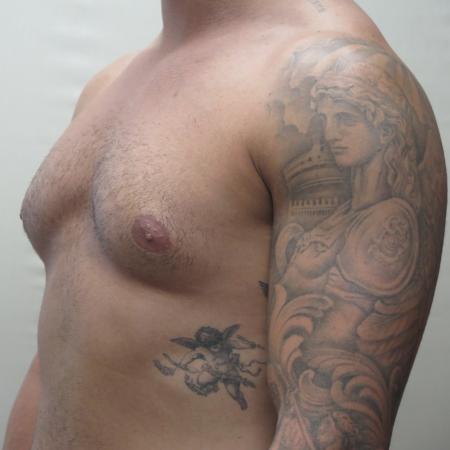 Before image 2 Case #124681 - Gynecomastia Patient #1563 
