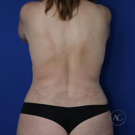 After image 5 Case #124901 - Implant exchange, lift, circumferential lipo, TT
