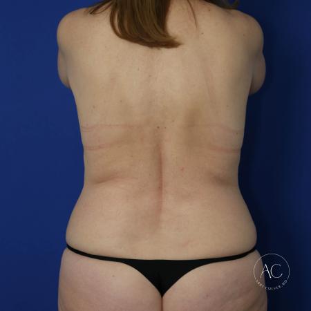 Before image 5 Case #124901 - Implant exchange, lift, circumferential lipo, TT