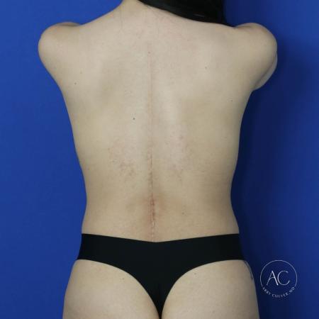 Before image 5 Case #124906 - Breast lift with implants and abdominoplasty