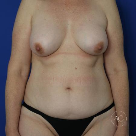 Before image 1 Case #124901 - Implant exchange, lift, circumferential lipo, TT