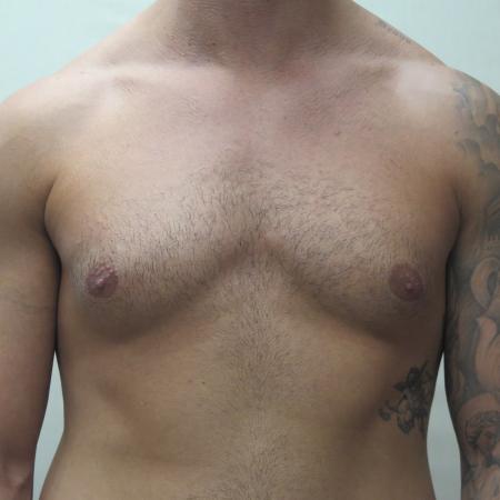 Before image 1 Case #124681 - Gynecomastia Patient #1563 