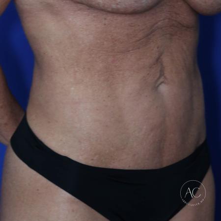 Before image 2 Case #124936 - Abdominoplasty