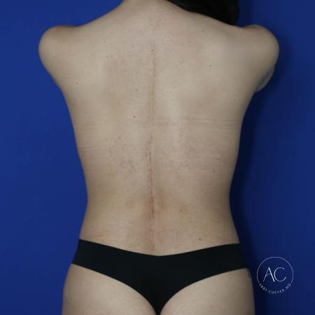 After image 5 Case #124906 - Breast lift with implants and abdominoplasty