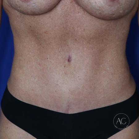 After image 1 Case #124936 - Abdominoplasty