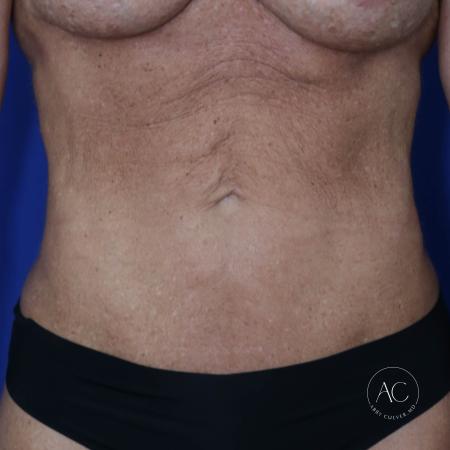Before image 1 Case #124936 - Abdominoplasty