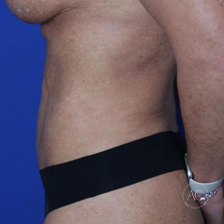 Before image 3 Case #124936 - Abdominoplasty