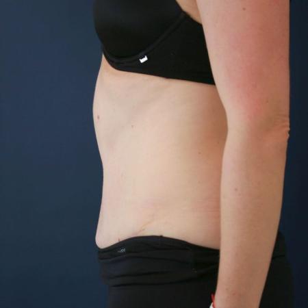 After image 3 Case #124866 - Abdominplasty