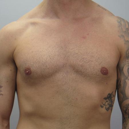 After image 1 Case #124681 - Gynecomastia Patient #1563 