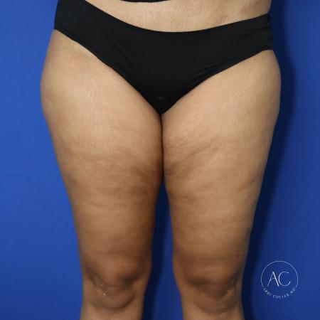 Before image 1 Case #125801 - Thigh liposuction