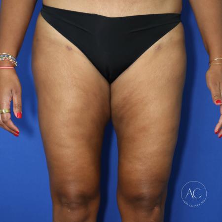 After image 1 Case #125801 - Thigh liposuction