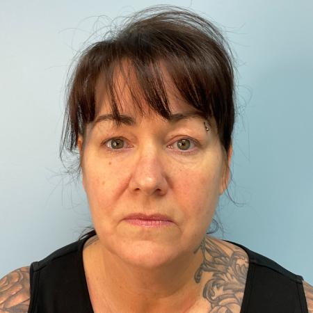 Before image 1 Case #125501 - Necklift & Lower face lift with Renuvion