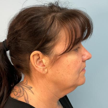 Before image 2 Case #125501 - Necklift & Lower face lift with Renuvion