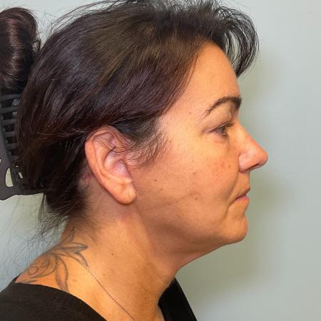 After image 2 Case #125501 - Necklift & Lower face lift with Renuvion