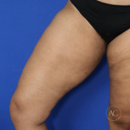 Before image 2 Case #125801 - Thigh liposuction