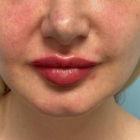 After image 1 Case #126051 - 31-year-old female Lip Enhancement 