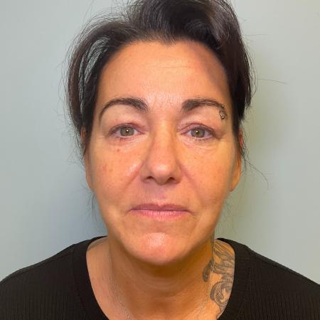 After image 1 Case #125501 - Necklift & Lower face lift with Renuvion
