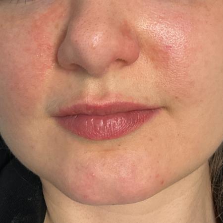 Before image 1 Case #126051 - 31-year-old female Lip Enhancement 