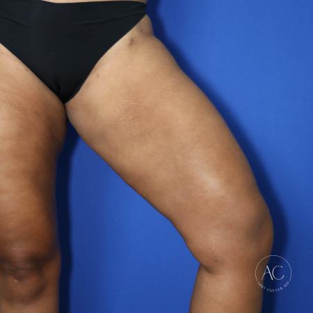 After image 3 Case #125801 - Thigh liposuction