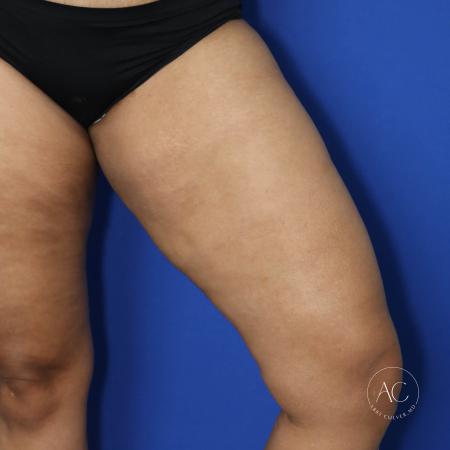 Before image 3 Case #125801 - Thigh liposuction