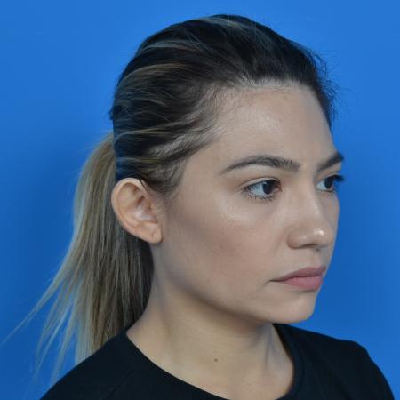 Before image 2 Case #126176 - otoplasty and earlobe repair