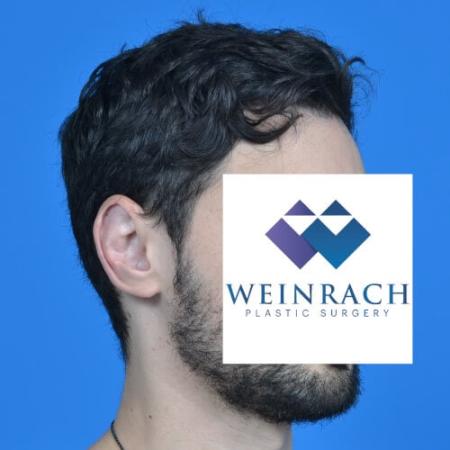 After image 2 Case #126571 - Otoplasty 32 year old