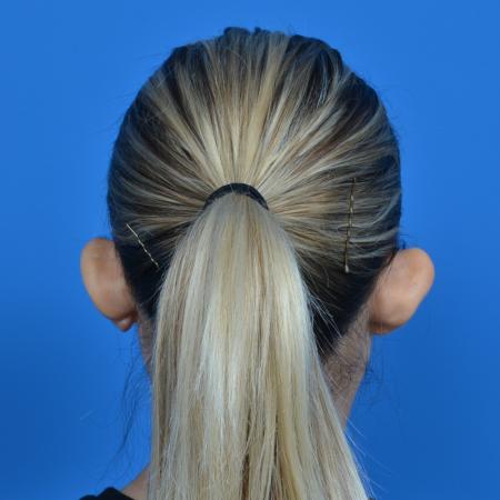 Before image 4 Case #126176 - otoplasty and earlobe repair