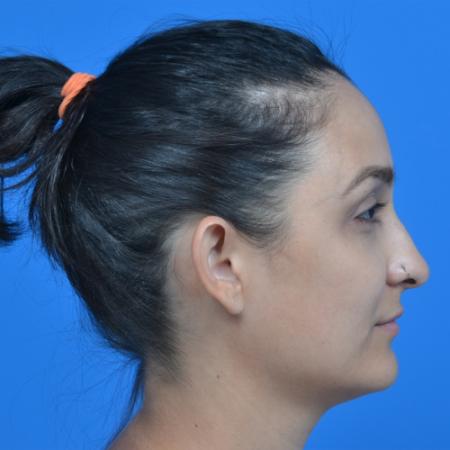Before image 3 Case #126236 - otoplasty 27 year old woman