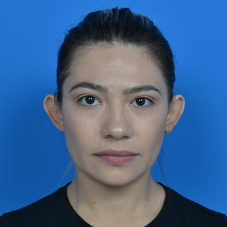 Before image 1 Case #126176 - otoplasty and earlobe repair