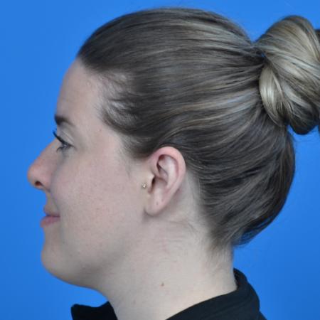 After image 3 Case #126576 - otoplasty 31 year old woman