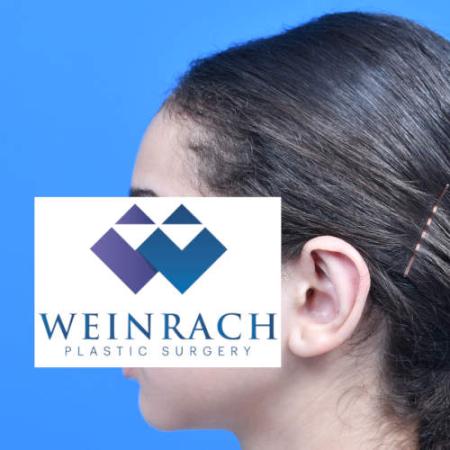 After image 3 Case #126221 - Otoplasty 11 year old