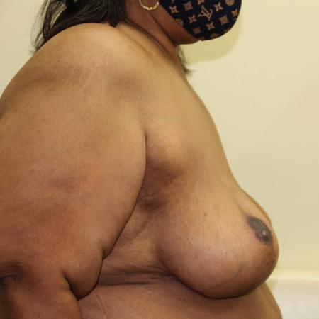 After image 2 Case #126866 - Breast reduction with free nipple graft